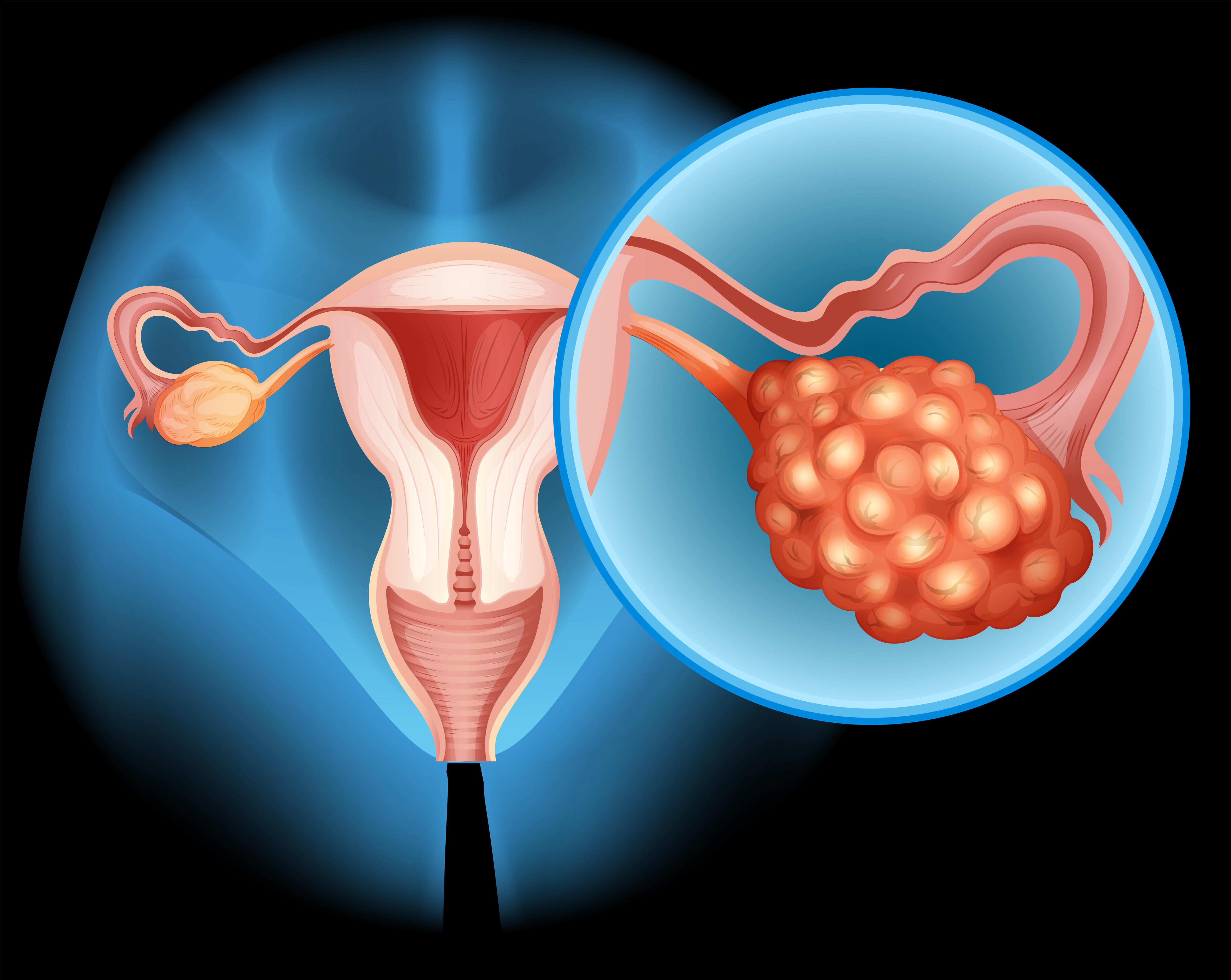 Ovarian Cyst Treatment